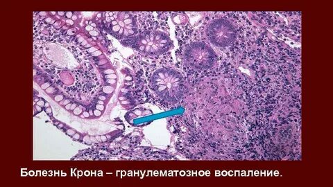 Гранулематозное воспаление