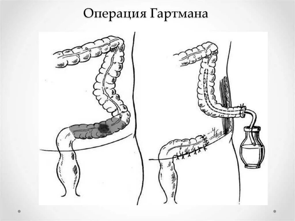 Операция Гартмана прямой кишки схема. Колостома операция Гартмана. Операция Гартмана на прямой кишке. Операция Гартмана опухоли кишки. Отзывы после операцией кишечника