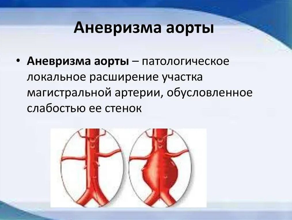 Аневризма аорты сердца что это симптомы лечение