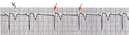 Малый прирост r v1 v3. Отрицательный qrs в v1 v2 v3. малый прирост r v1-v3 на экг. малый прирост зубца r v1-v3. недостаточный прирост зубца r в v1-v3 что это.