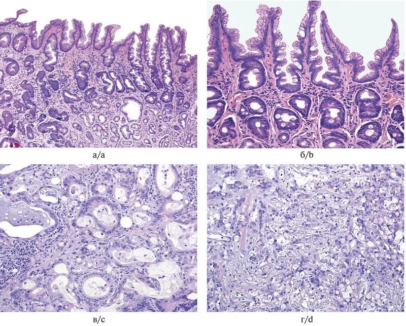 Метаплазия желудка отзывы. Кишечная метаплазия гистология. Кишечная метаплазия эпителия желудка гистология. Тонкокишечная метаплазия гистология. Кишечная метаплазия желудка гистология.