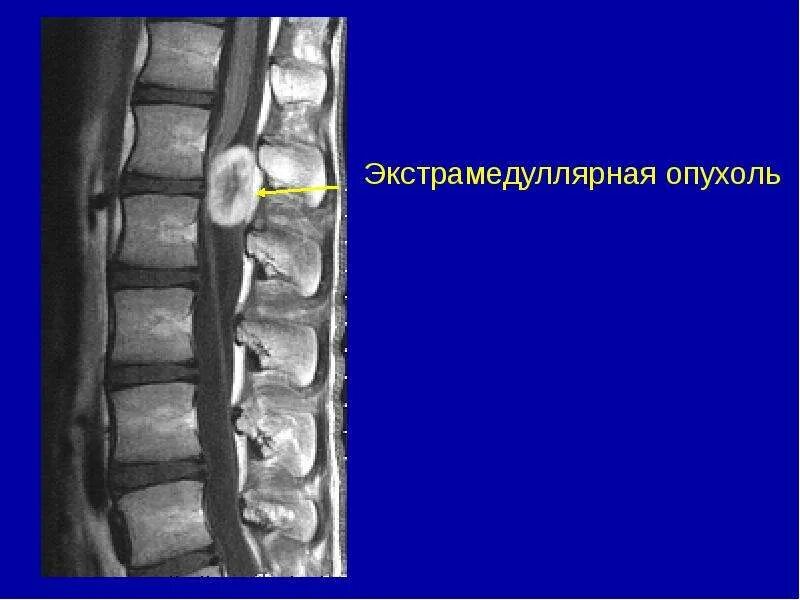 Классификация опухоль спинного мозга мрт. Опухоль спинного мозга кт позвоночника. Интрамедуллярные опухоли спинного мозга мрт. Киста спинного мозга поясничного отдела. Опухоль в поясничном отделе