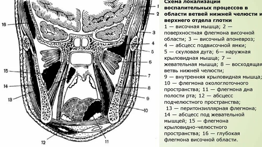 Пространства полости рта. Окологлоточное клетчаточное пространство схема. Крылочелюстного пространства абсцесс крылочелюстного. Схема Рудько флегмон. Клетчаточное пространство дна полости рта.