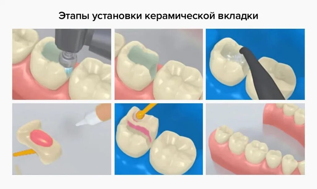 Культевая вкладка для зубов в стоматологической клинике Вегастом Клиника Вега*ст