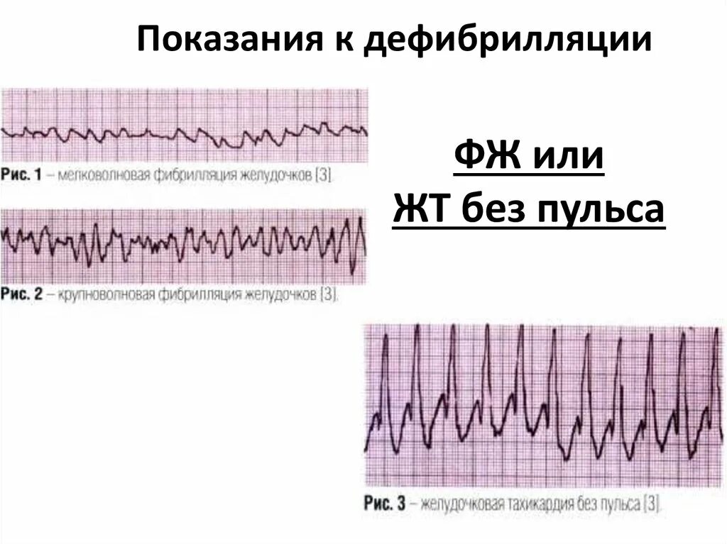 Дефибрилляция при асистолии. Фибрилляция желудочков дефибрилляция. желудочковая тахикардия дефибрилляция. крупноволновая фибрилляция желудочков на экг. показания к дефибрилляции.