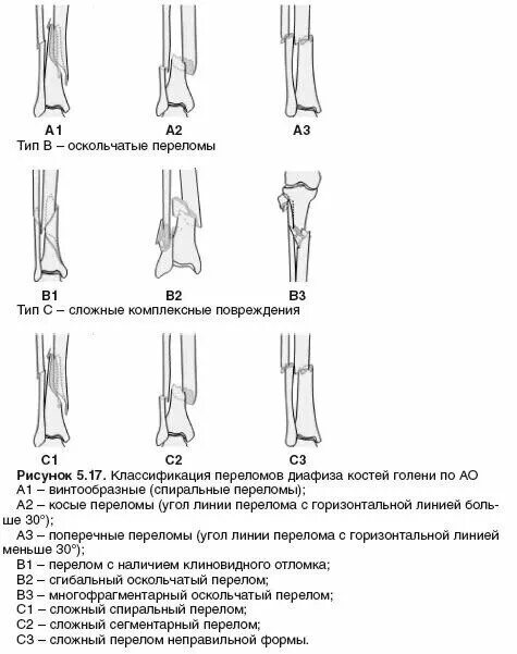Перелом берцовой кости как разработать. Переломы большеберцовой кости классификация. классификация диафизарных переломов костей голени. классификация переломов диафиза бедренной кости по ао. переломы костей голени классификация.