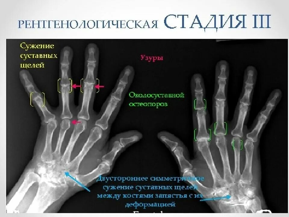 Ревматоидный артрит 1 стадия на рентгене. Ревматоидный артрит кисти рентген. Ревматоидный артрит 1 степени рентген. 28 Суставов ревматоидный артрит.