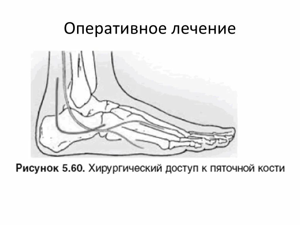 Операция пяточной кости. Перелом пяточной кости остеосинтез. Перелом пяточной кубовидной кости. Внутрикостный перелом пяточной кости. Перелом пяточной кости пациент.