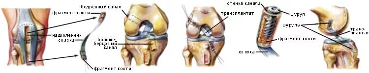 Связка для надколенника для ПКС. Артроскопия пластика крестообразной связки. Артроскопия связки надколенника. Аутотрансплантация связки коленного сустава. Операция колено пкс