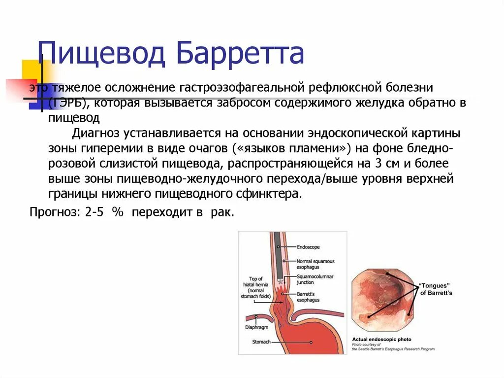 Пищевод Барретта презентация. Пищевод Барретта классификация. Презентация пищевода