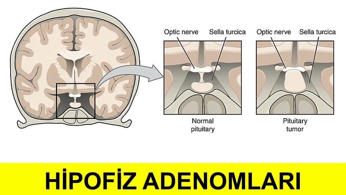 Гипофиз лечение. Эндоселлярное образование гипофиза. Аденома передней доли гипофиза. Аденома гипофиза головного мозга что это такое. Микроаденома гипофиза головного мозга 5 мм.