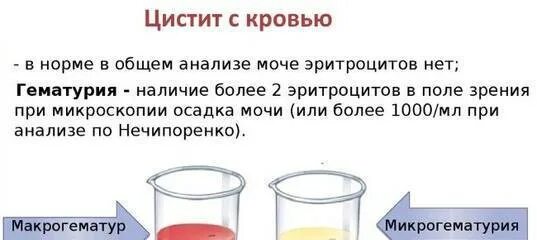 Нормально пописать. Кровь в моче при цистите. Моча с примесью крови. Обнаружение крови в моче это.