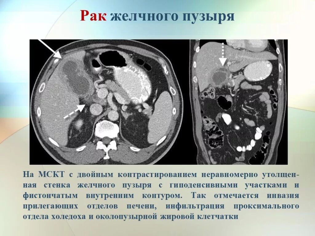 Отек желчного пузыря. Утолщение стенки желчного пузыря кт. Аденокарцинома желчного пузыря на кт. Кт брюшной полости желчный пузырь. Кт печени и желчного пузыря.