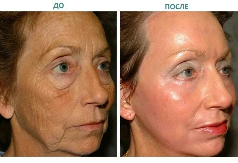 Лазерная шлифовка кожи цена skinlift ru. Фраксель лазерная шлифовка век. Фракционный лазерный термолиз. Наноперфорация рубцов. Фракционный лазерный термолиз со2.