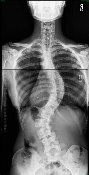 How My Daughter's Spinal Fusion Changed My Parenting Style Forever YourTango