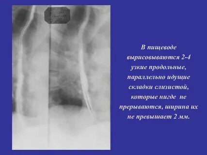 Складки слизистой продольно