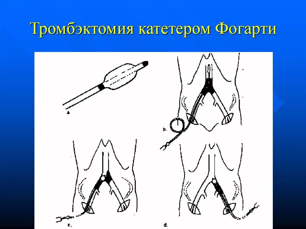 Катетер фогарти. Эмболэктомия катетером Фогарти. Тромбэктомия техника катетер Фогарти. Катетер Фогарти холедохотомия.