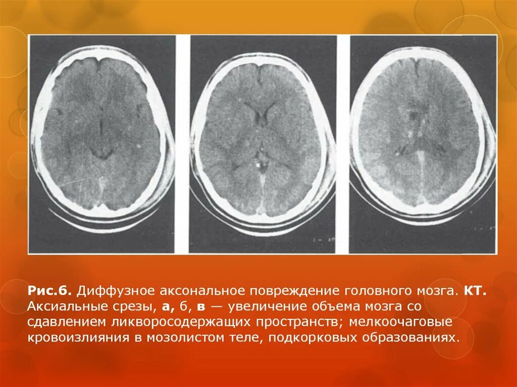 Гиподенсивный очаг кт головного мозга. Перивентрикулярный отек головного мозга на кт. Отёк головного мощга кт.