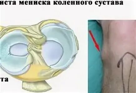 Мениск коленного сустава последствия