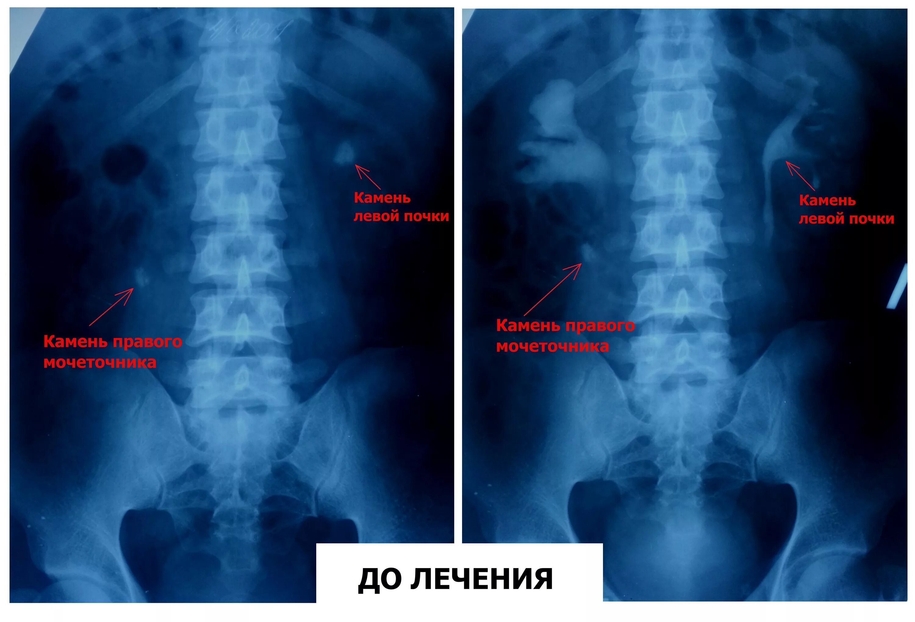 Камень левого мочеточника. Обзорная урография камни в почках. Обзорная урограмма мочекаменная болезнь. Конкремент почки рентген. Мочекаменная болезнь экскреторная урография.