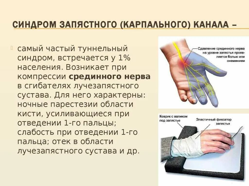 Синдром запястного канала симптомы. Туннельный синдром запястного канала. синжромзапястногоканала. синдром запястноооканала. туннельный синдром запя.