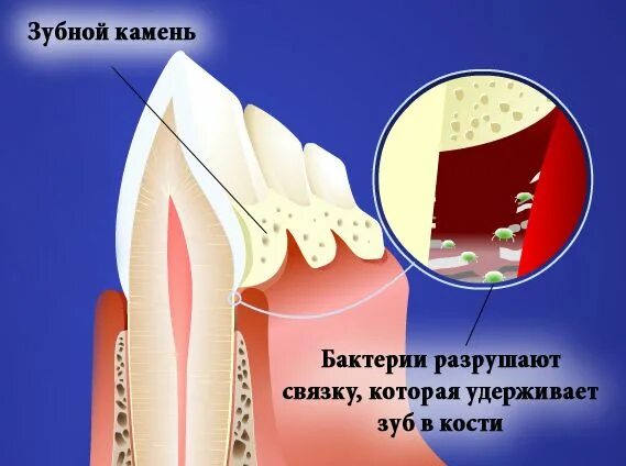 Удалить зуб саранск. Процесс образования зубного камня. микроорганизмы зубного камня.