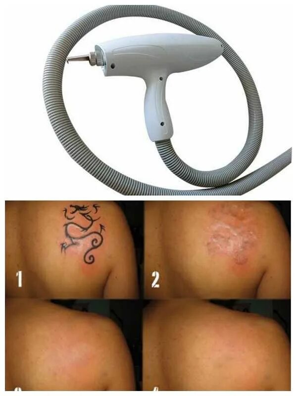 Удаление тату неодимовым. Skin неодимовый лазер (лазерный аппарат. Лазер для уловления тату. Выведение татуировок лазером.