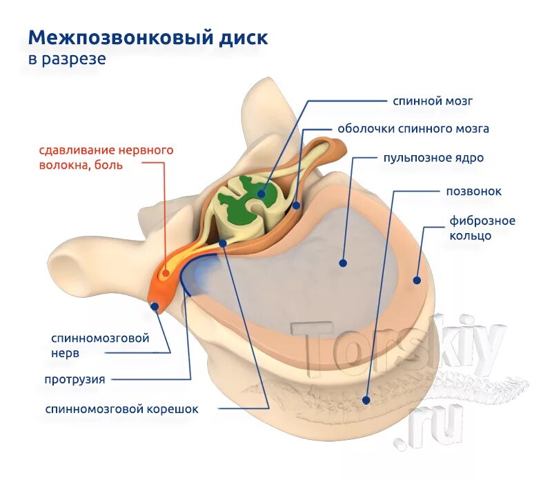 Содержимое межпозвоночного диска. Из чего состоит Позвоночный диск. Межпозвоночный диск состоит. Межпозвонковый диск состоит. Из чего состоит межпозвоночный диск.