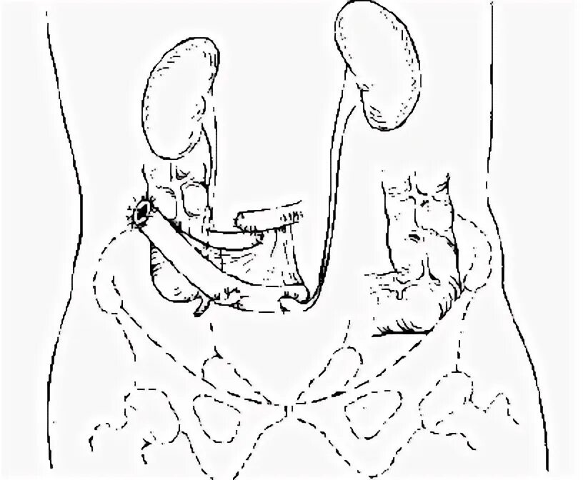 Цистэктомия операция брикера. Операция брикера. Операция брикера мочевого пузыря. Кондуит мочевого пузыря. Цистэктомия мочевого пузыря.