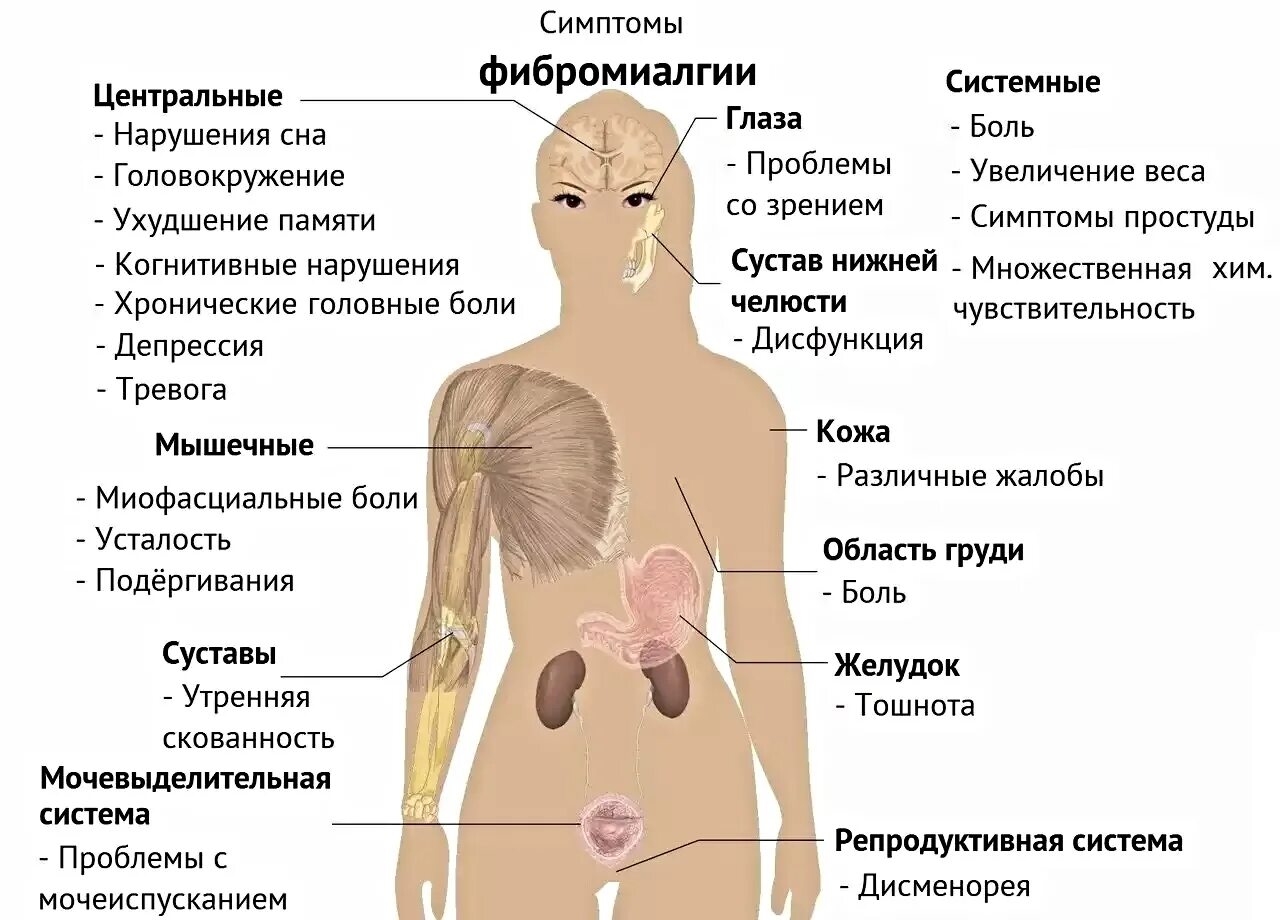 Симптомы заболеваний внутренних органов. Фибромиалгия. симптомы фибромиалгии. точки фибромиалгии. критерии фибромиалгии.