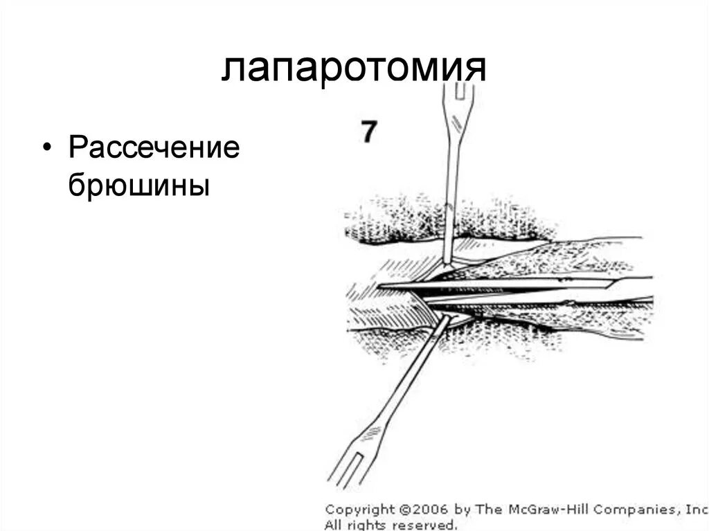 Техника рассечения париетальной брюшины. Рассечение лапаротомия. Книга рассечение стоуна