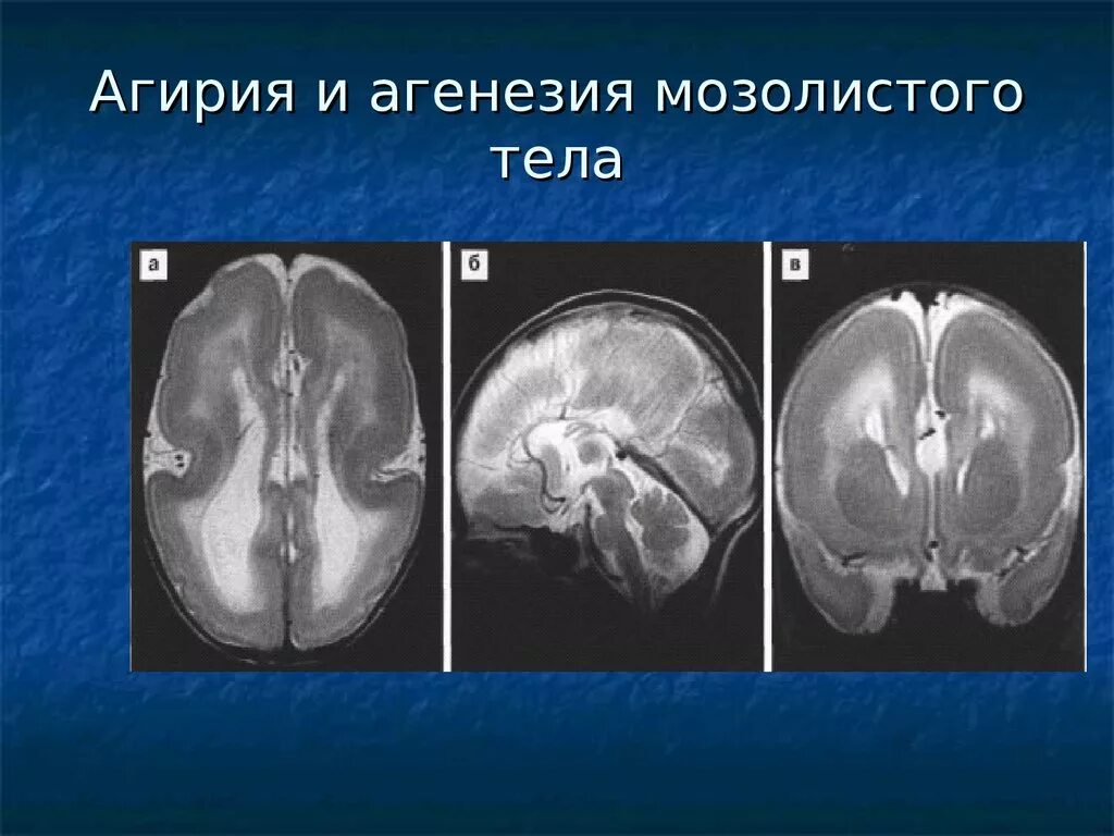 Миллера дикера. Лиссэнцефалия-пахигирия. Лиссэнцефалия головного мозга у плода. Агирия головного мозга. Агенезия головного мозга.