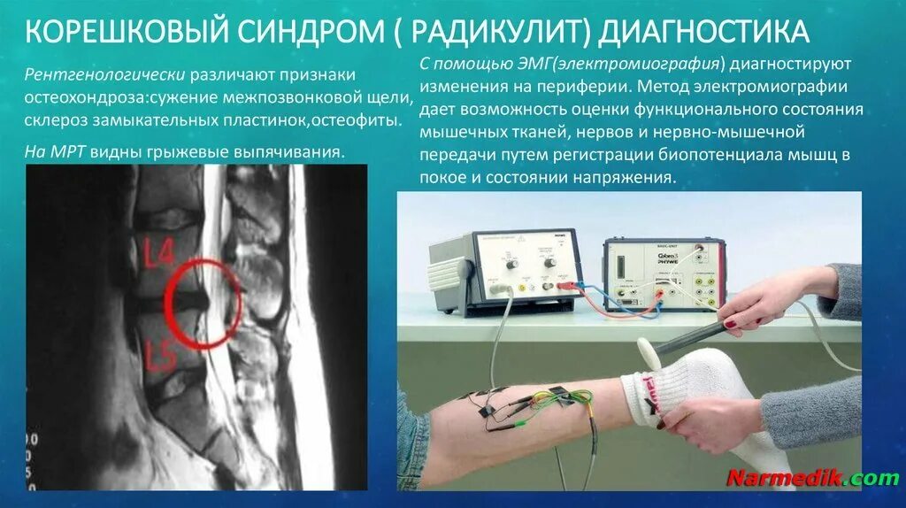 Стимуляционная электронейромиография нижних конечностей. Эмг исследование энмг. Мрт энмг. Электронейромиография научный центр здоровья. Диагноз корешковый синдром.