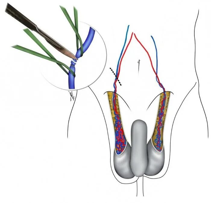 Расширение вен канатика. Варикоз вен семенного канатика. Варикоцеле операция Мармара. Варикозное расширение вен семенного канатика яичка.. Шрам варикоцеле Мармара.