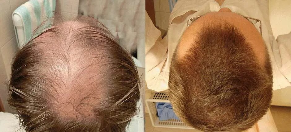 Отзывы рост волос на голове. Алерана миноксидил 5. Миноксидил алерана эффект. Алерана миноксидил 5% до и после.