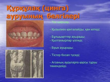 Цынга
