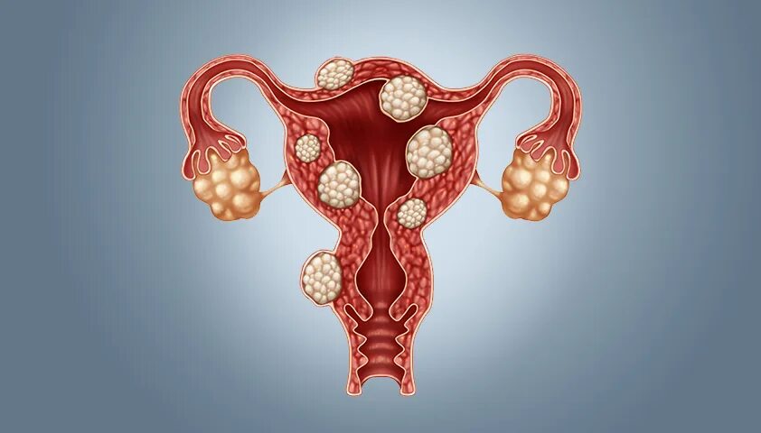 Миома матки болит живот. Яичники у женщин. Патологии яичников у женщин.