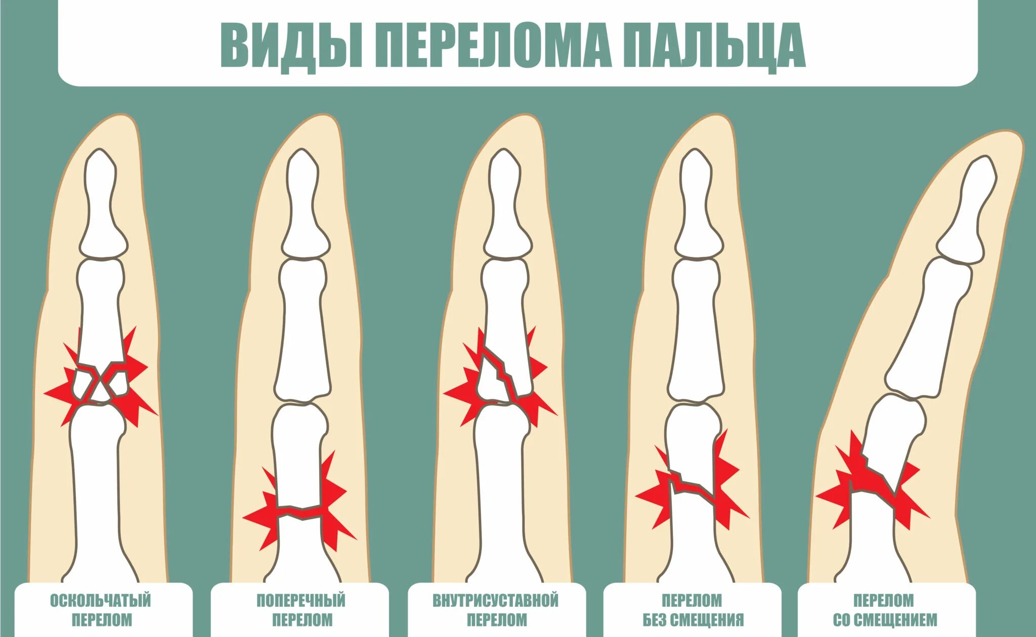 Перелом фаланги пальца на руке. Перелом фаланги мизинца. Перелом ногтевой фаланги. Перелом средней фаланги мизинца.