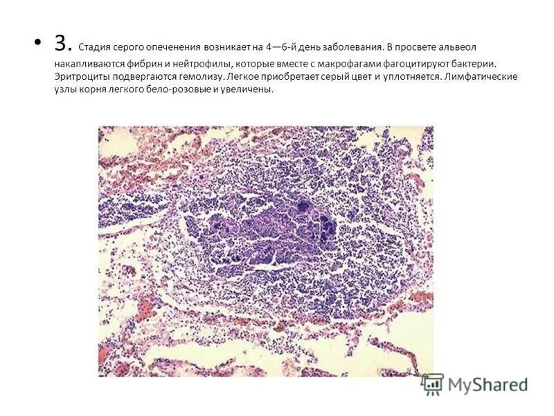 стадия опеченения при пневмонии. стадия опеченения при пневмонии. крупная пневмония макропрепаратпрепарат. стадии крупозной пневмонии. крупозная пневмония стадия красного опеченения.