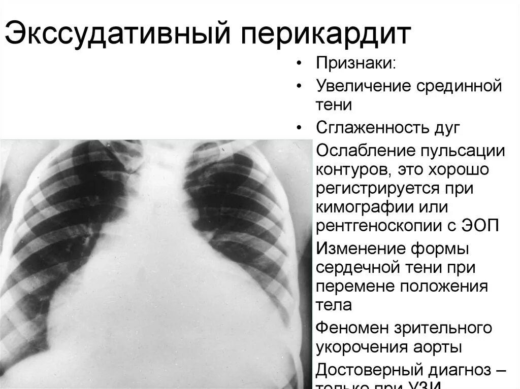 Перикардиты госпитальная терапия. Признаки перикарда. Констриктивный (сдавливающий) перикардит. Признаки перикарда. Признаки перикарда.