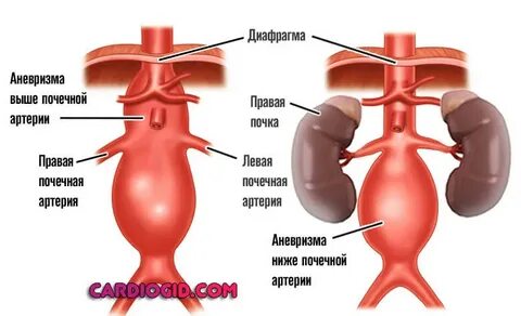 Почечная аневризма