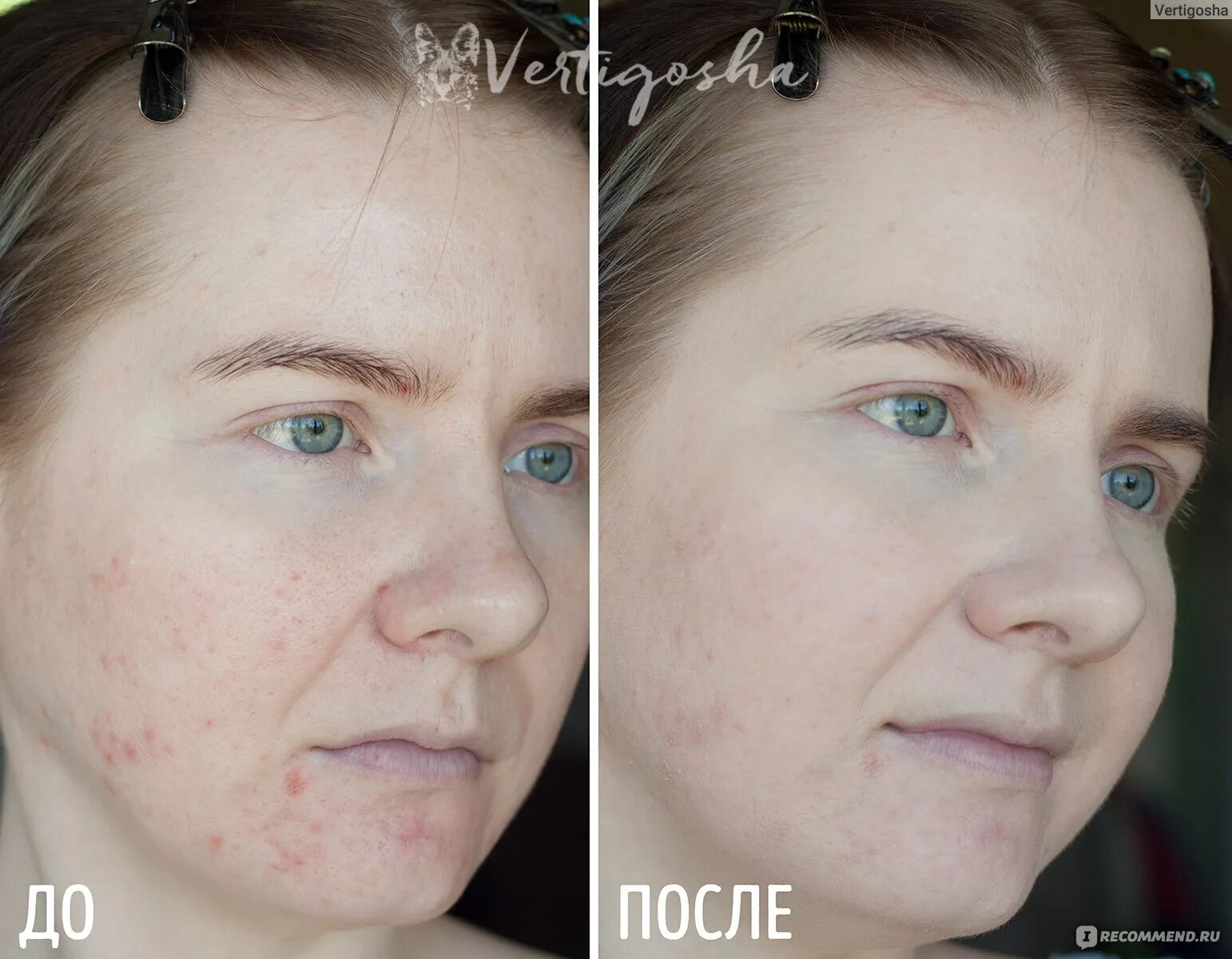 Acne fighter отзывы. Тоналка acne fighter. тональный крем бьюти бомб acne fighter.
