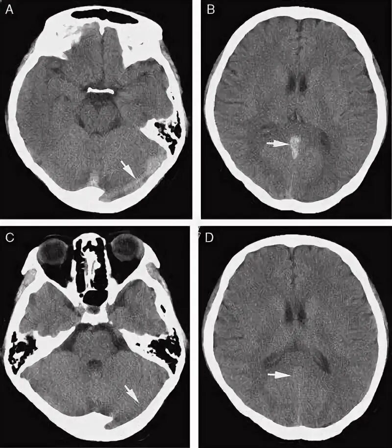 Тромбоз пещеристого синуса кт. Тромбоз синусов головного мозга кт. Тромбоз кавернозного синуса на кт. Тромбоз кавернозного синуса клиника. Тромбоз на кт