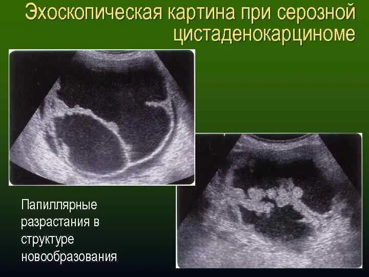 Цистаденома яичника на УЗИ. Папиллярные кисты яичников УЗИ. Папиллярная серозная цистаденома. Папиллярная цистаденома яичника. Серозная пограничная опухоль