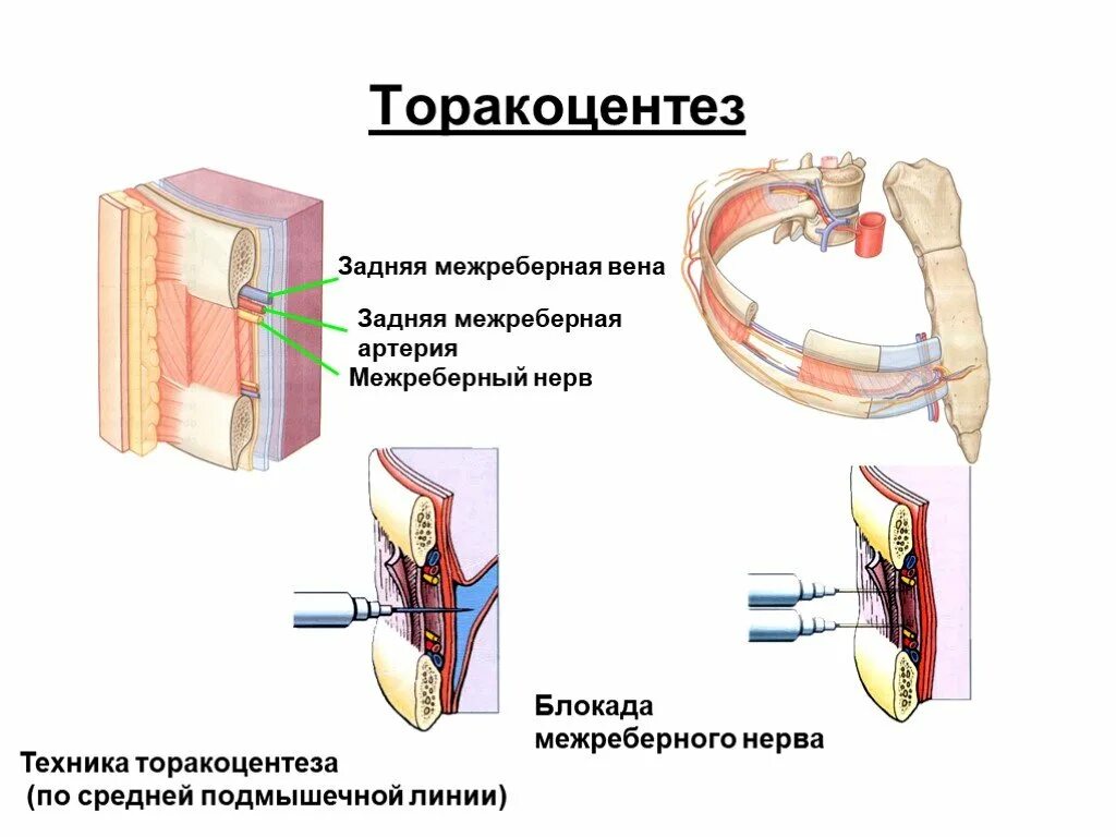 Межреберная блокада. Торакоцентез. Торакоцентез методика. Плевральная пункция торакоцентез. Межреберные артерии.