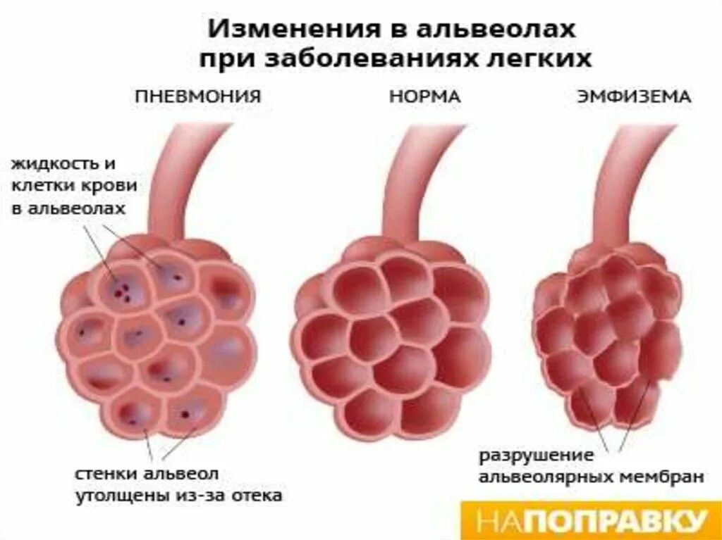 Альвеолярная буллёзная эмфизема.