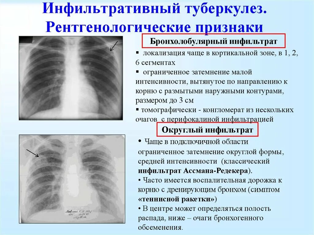 Бронхолобулярный инфильтрат рентген. Инфильтративный туберкулёз лёгких рентген. Инфильтративный туберкулез рентген диагностика. Очагово-инфильтративный туберкулез рентген. Наличие очаговых изменений