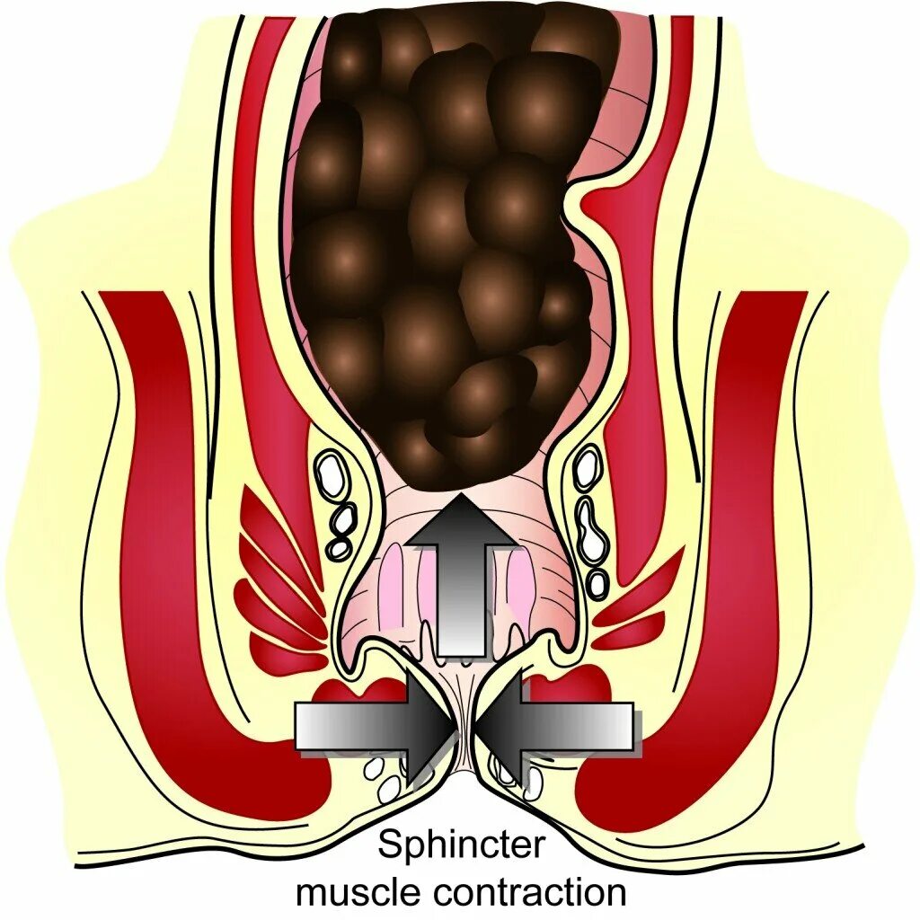 Спазм сфинктера прямой