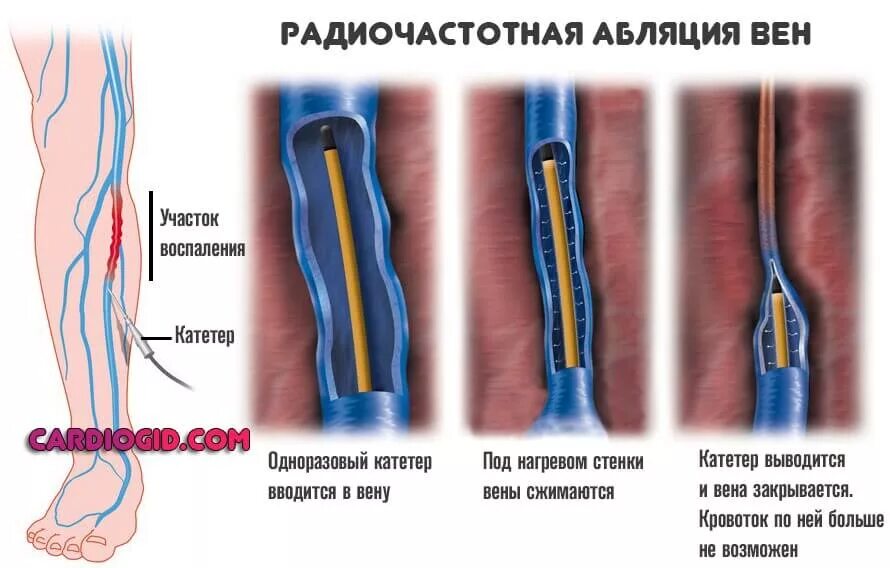 Где делают абляцию. Радиочастотная облитерация (РЧО) вен нижних конечностей. Высокочастотная абляция вен нижних конечностей. Радиочастотная абляция варикоза.