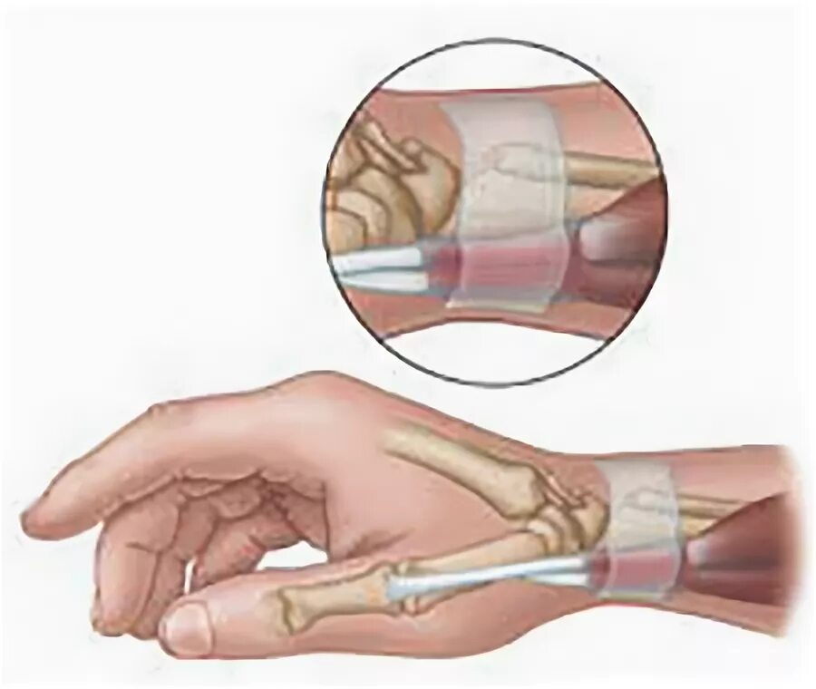 Теносиновит сухожилия кисти. Тендовагинит сухожилий предплечья. Болезнь де Кервена кисти. Болезнь де Кервена тендовагинит. Тендовагинит де Кервена кисти.